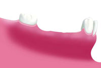 Bild 3: Fehlende Zähne in einer Zahnreihe