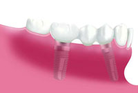 Bild 4: Implantatversorgung mit einer Brücke