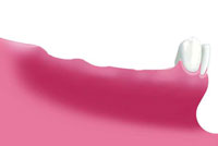 Bild 1: Mehrere fehlende Zähne