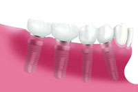 Bild 2: Implantatversorgung mit mehreren Kronen