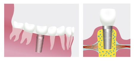 Grafik zum Aufbau eines Implantats
