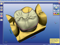 Cerec 3D
