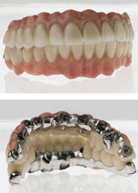 Kombinierter Zahnersatz